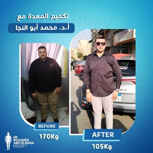 تجاربكم مع تكميم المعدة